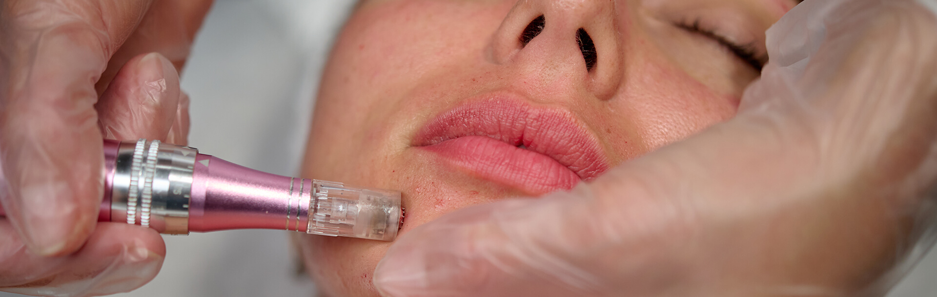 Burlington Esthetician, Microneedling and Facials